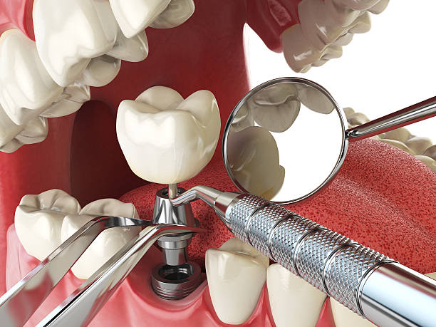 Best Knocked-Out Tooth Emergency  in Clinton, WA